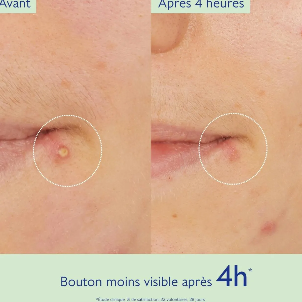 CAUDALIE Peaux À Tendance Acnéique|Crèmes & Fluides^Stop Boutons Salicylique l'Acide Salicylique